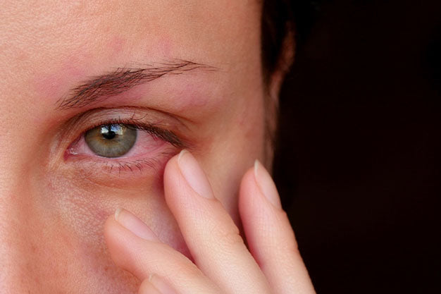 10 Common Eye Infection Symptoms | Causes & Treatment Inside